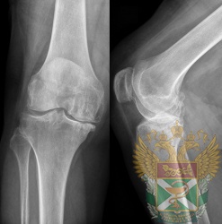 Рентген - Асептика в колене